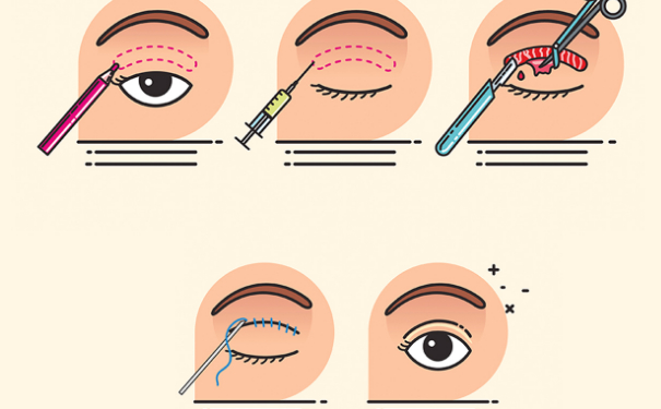 北京清木医疗美容诊所做双眼皮120天案例恢复过程&技术怎么样?