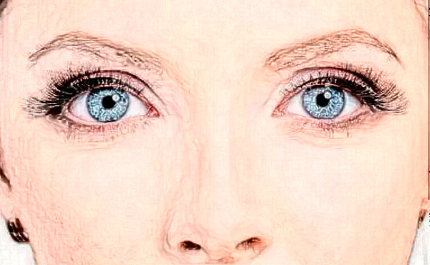 福州长乐仁和医院新月双眼皮技术评测怎么样?术后半年案例揭秘