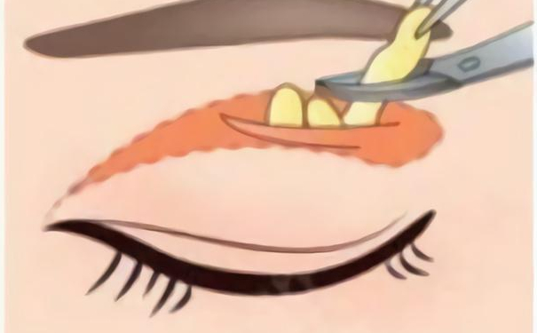 安徽宿州惠尔美医疗整形美容扇形双眼皮技术怎么样?120天术后恢复案例|一般多少钱