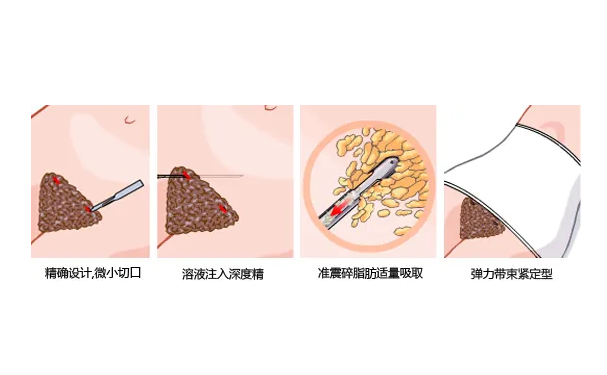 佛山顺德壹加壹美容医院共振吸脂技术级别怎么样?案例点评&费用明细
