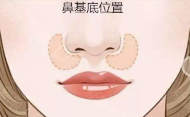山东省立医院孟真鼻唇沟填充120天案例欣赏(效果怎么样?技术水准)