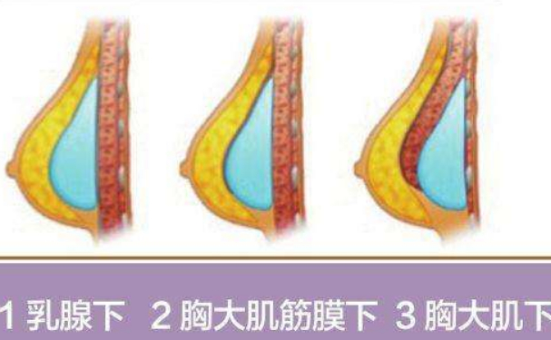 广西医科大学第一附属医院隆胸技术怎么样?口碑详情|价目一览表